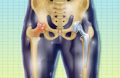 Hip-Replacement-Surgery