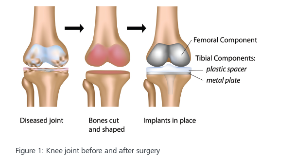 knee surgery dr shankar prasad